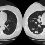 Hacker Rubano ricerca sul Cancro