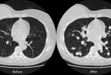 Hacker Rubano ricerca sul Cancro